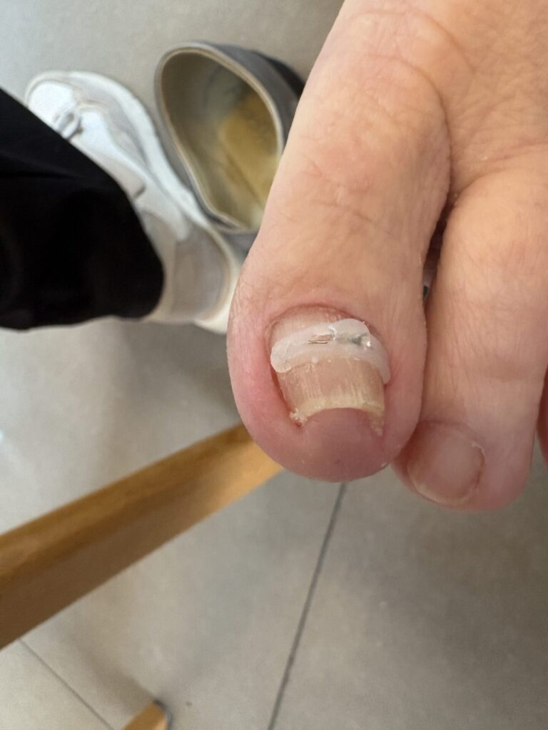 Close-up of a bandaged toe